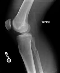 The maisonneuve fracture consists of a proximal fibular fracture with associated syndesmotic ligament disruption and injury to the medial ankle structures. Maisonneuve Fracture Wikipedia