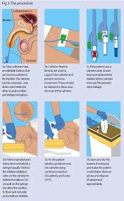 urinary catheters 6 removing an indwelling urinary catheter