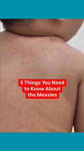 Image result for measles