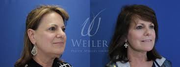 Facelift Before and After Photo Gallery