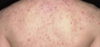 طفح جلدي حبوب تشبه الجدري. Ø§Ø³Ø¨Ø§Ø¨ Ø¸Ù‡ÙˆØ± Ø­Ø¨ÙˆØ¨ ÙÙŠ Ø§Ù„Ø¬Ø³Ù… ÙƒÙ‚Ø±Øµ Ø§Ù„Ù†Ø§Ù…ÙˆØ³ Ù…Ù€Ù‚Ù€Ø§Ù„Ø§ØªÙ€ÙŠ