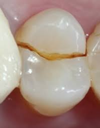 Ursachen Fur Langsfrakturen Endodontie Dr Eggert