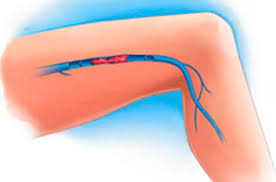 Consecuencia general que se produce cuando ese trombo, que está en la pierna, se suelta y llega al pulmón, esta sería la más grave de las dos.; La Escleroterapia Con Espuma Centro Venas Barcelona