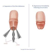 Circumcision surgery is carried out across the world for various cultural or religious reasons. Evidence And Ethics On Circumcision Evidence Based Birth