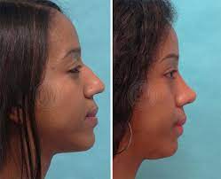 Dr Guy Watts Plastic Surgeon Perth Rhinoplasty