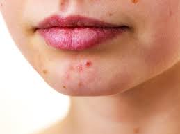 One of the telltale signs of a hormonal breakout is its location on the face. What Is It Perioral Dermatitis Vs Acne Balmonds