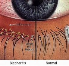 Blepharitis Is A Common Eye Condition Typically Causing A Build Up Of Matter Around The Base Of Eye Lash Eyelash Extensions Care Blepharitis Eyelash Extensions