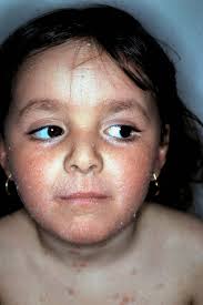 The Ichthyoses: The common thread in a life of investigation or Making a  professional life from the study and treatment of d