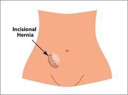 Image result for stomach hernia symptoms
