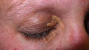 Some xanthomas resolve with successful treatment of the underlying dyslipidaemia: Xanthelasma Treatment Causes Photo And More