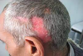 Red light therapy stimulates the scalp tissues by increasing the number of red corpuscles, and oxygen and nutrients are delivered to the hair bulb. Scalp Biopsy And Diagnosis Of Common Hair Loss Problems Intechopen