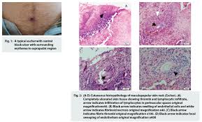 Circumferential burns, generally deep second or third degree in nature, whether of the extremities or of the trunk, can cause compression of the underlying soft tissues as burn edema develops beneath an unyielding eschar. Welcome To Journal Of The Association Of Physicians Of India