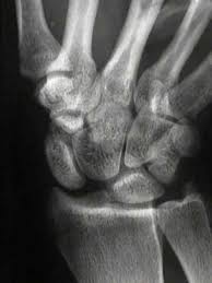 Image result for Scaphoid Shift Test