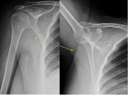 Pain is not a common symptom of breast cancer. Epos Trade