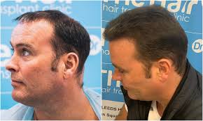 3. before-after-left. ben-thornley.png