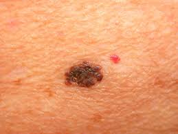 Read on to know more. Early Stage Melanoma Treatment Options