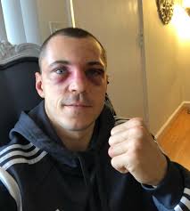 Scott Quigg shows off gruesome face wounds after points loss to Oscar  Valdez but insists he will come back stronger