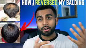 Some of the most common signs of balding include a receding hairline, more hair appearing in the sink and shower, and a sudden change in how your hair reacts to brushing. 6 Things I Ve Used To Reverse My Hair Loss My Ideal Hair Growth Routine Hair Update Youtube