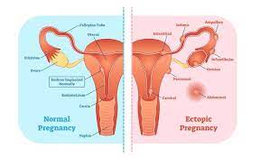 Uterus Pain Learn About The Causes And Treatment In Early Pregnancy Medanta