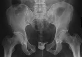 Learn vocabulary, terms and more with flashcards only rub 220.84/month. Pelvic Fracture Chapter 15 Trauma