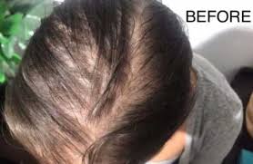 It won't rescue a receding hairline. Scalp Micropigmentation For Women Perth Hair Tattoo My Transformation