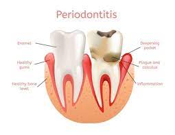 What Is Periodontal Disease? How To Treat Gum Disease? -  Missionimplantcenter