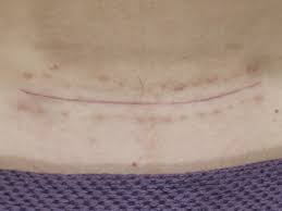 Tratamiento De Fisioterapia Para La Cicatriz De La Cesarea Clinica Angular