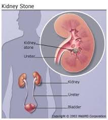 Yi Dan Formula For Kidney Stones Removal An Effective Chinese Herbal Remedy Renal Calculi Kidney Stones Kidney Stones Remedy