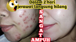 Cream dr pure telah teruji secara klinis sehingga cream dr pure bisa menjadi pilihan terbaik dalam memutihkan sekaligus perawatan kulit wajah. Menghilangkan Jerawat Cepat Cream Dr Pure Youtube