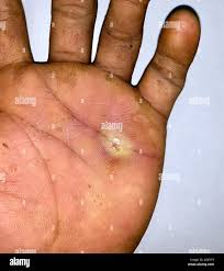 Image result for Hand Infection