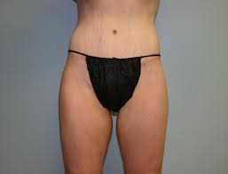 Thigh Lift Surgery In Houston Tx Dr Leo Lapuerta