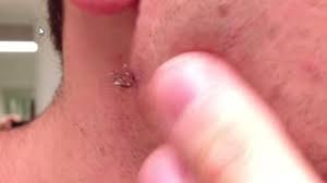 Then wash off the mixture with clean water. Disgusting Ingrown Hair