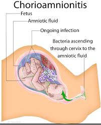 Image result for Chorioamnionitis