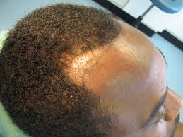 These can result in damaged hair. Afro Hair Transplant Westminster Clinic