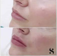 5 out of 5 stars. Lip Fillers Dermal Fillers In Leeds Beautiful Skin At The Right Price