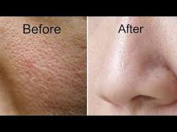 How To Get Rid Of Large Pores In 3 Days Get Smooth Fairer And Tighter Skin Youtube Oily Face Skin Pores Tighter Skin