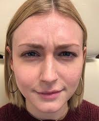 Before & After Botox Injections