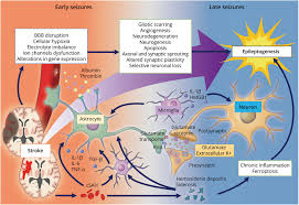 Image result for Stroke Pathophysiology