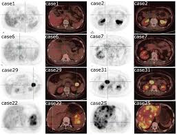 It takes pictures from different angles. 18f Fdg Pet Ct Can Be Used To Detect Non Functioning Pancreatic Neuroendocrine Tumors