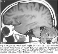 Encefalitis Herpetica En Varon De 30 Anos