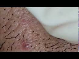 While ingrown hairs may look a lot like pimples, they're actually foreign body reactions that occur when something goes wonky in your hair follicle, explains dr. Ingrown Hair Biggest Ingrown Hair