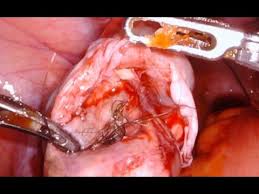 Check spelling or type a new query. Ovarian Cyst With Hair Dermoid Da Vinci Robotic Surgery Dr Vidali Youtube