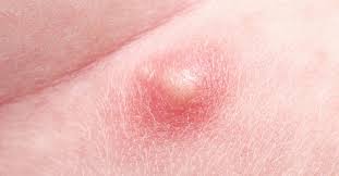 An ingrown hair on the penile shaft occurs when a hair grows into the skin. Pimple On Scrotum Causes Types And When To See A Doctor