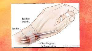 Penyebab jari tangan kebas lainnya menurut dr. Kaku Ibu Jari Tangan