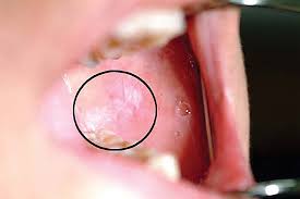 Oral cancer can be painless. Adjunctive Techniques For Mouth Cancer Screening Dentistry Online