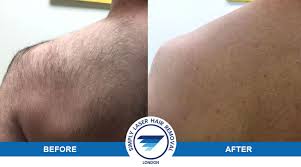 This means applying the cream to an inconspicuous part of the body, leaving on for the recommended period of time, then waiting at least a couple of hours to check for adverse reactions. Laser Hair Removal For Men