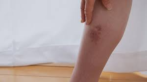 Image result for Cellulitis