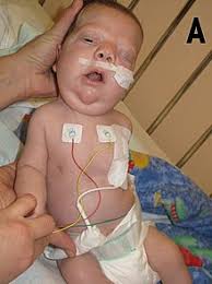 Noonan Syndrome Wikipedia