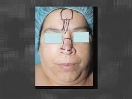 Reconstruccion nasal web