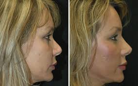 Rhinoplasty Before & After Photos in Beverly Hills